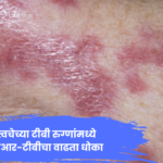 Drug Resistant TB : त्वचेच्या टीबी रुग्णांमध्ये औषध-प्रतिरोधक टीबीचा धोका दर्शवणारे वैद्यकीय चित्र