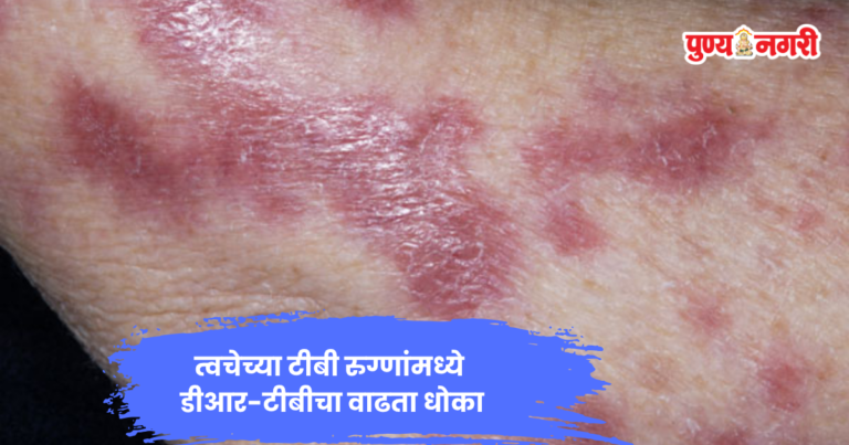 Drug Resistant TB : त्वचेच्या टीबी रुग्णांमध्ये औषध-प्रतिरोधक टीबीचा धोका दर्शवणारे वैद्यकीय चित्र