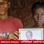 मादागास्करमध्ये अल्बिनिझम असलेल्या व्यक्तींच्या सुरक्षेचा आणि मानवाधिकारांचा प्रश्न