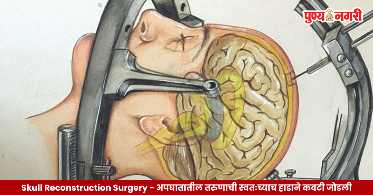 Doctors performing skull reconstruction surgery using the patient's own preserved skull bone after a severe road accident.
